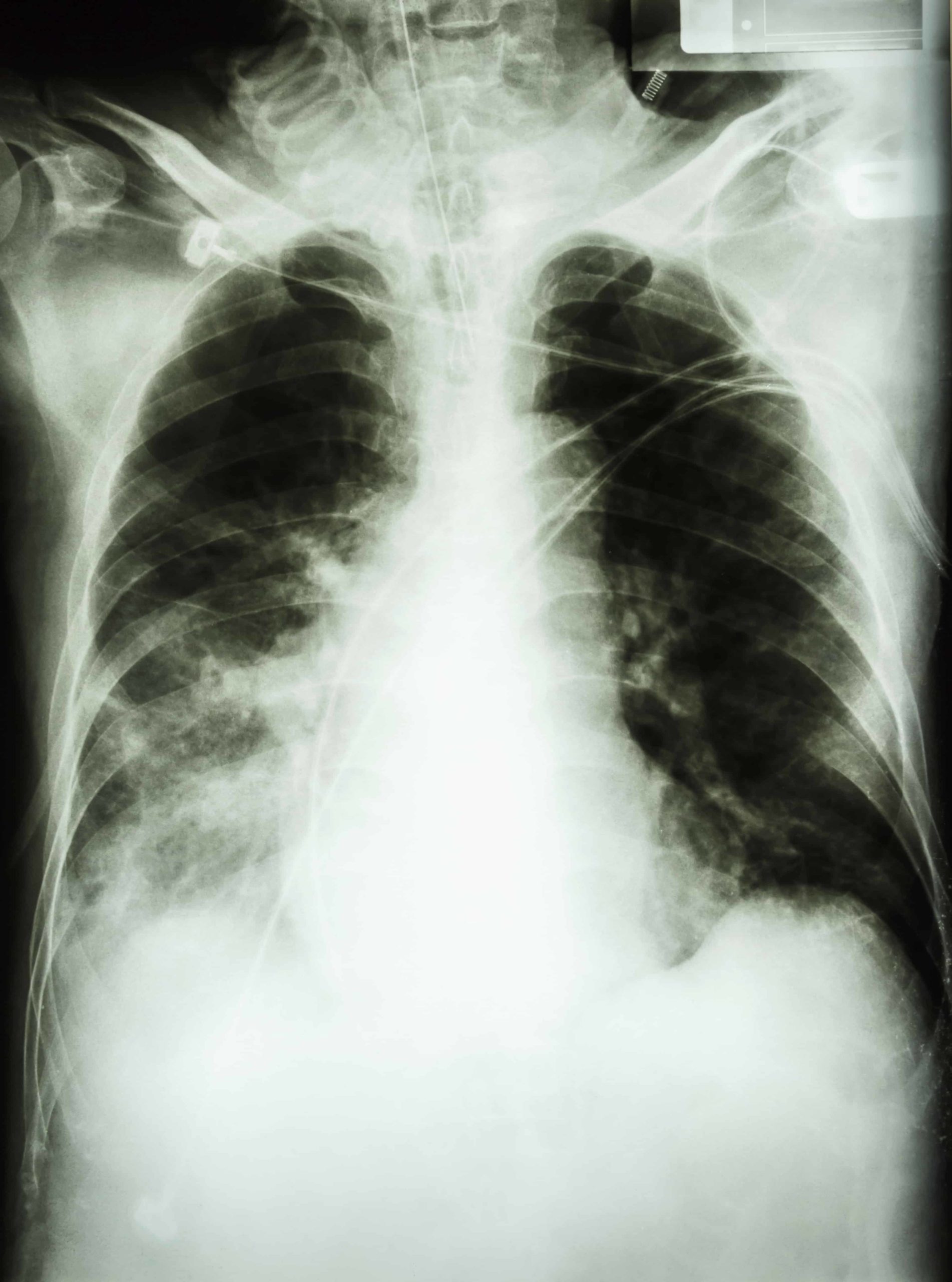 Chest X Ray Showing Pneumonia at andrewafort blog