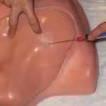 Subclavian Line Insertion