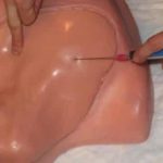 Subclavian Line Placement
