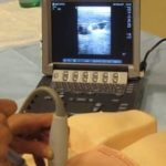 Ultrasound-Guided Central Line Insertion