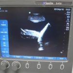 Ultrasound Guided Thoracentesis