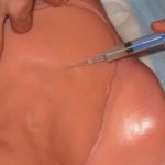 Training for Subclavian Central Venous Catheter Placement